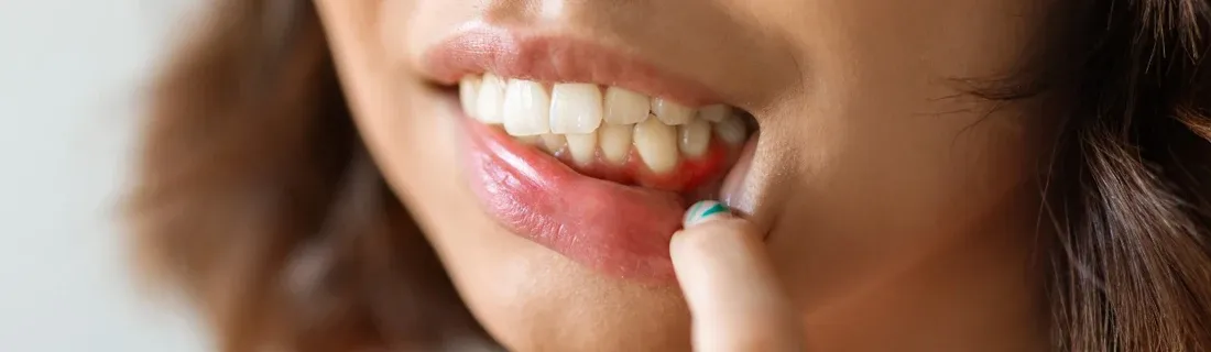 Close-up of a woman revealing red inflamed gums