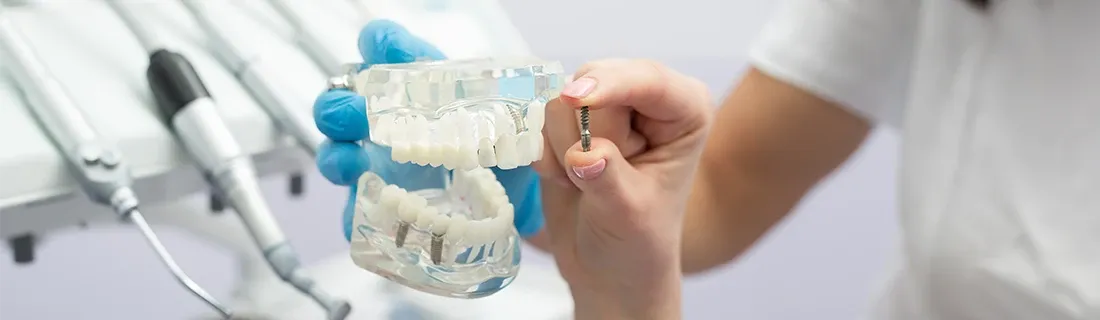 Dental Implants